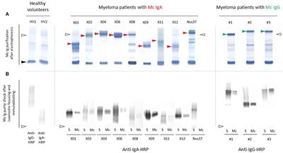 Analysis of the Targets and Glycosylation of Monoclonal IgAs From MGUS and Myeloma Patients